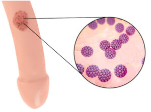 penis kanseri